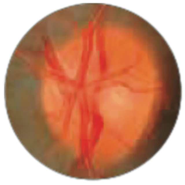 glaucoma - img-1