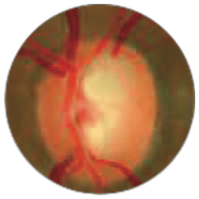 glaucoma - img-2