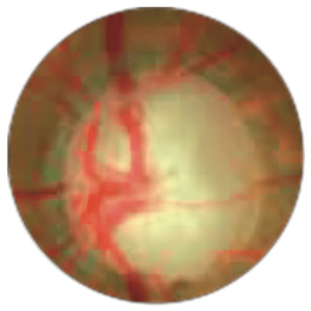 glaucoma - img-3